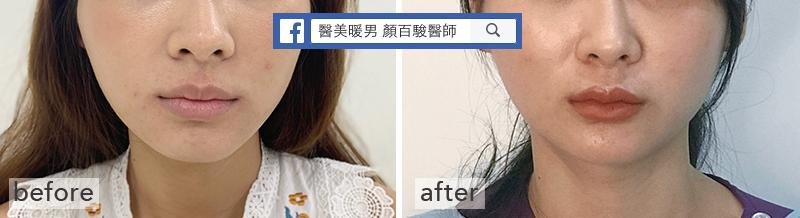 Read more about the article 自然、快速美唇 – 玻尿酸豐唇
