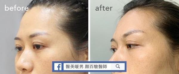 Read more about the article 豐額頭案例