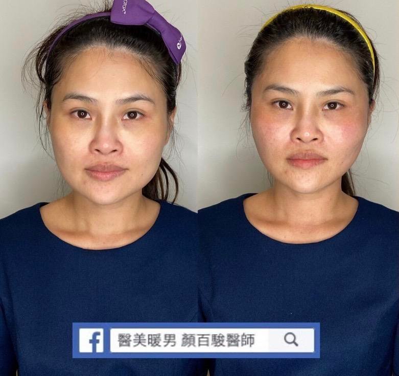 Read more about the article 中下臉埋線案例
