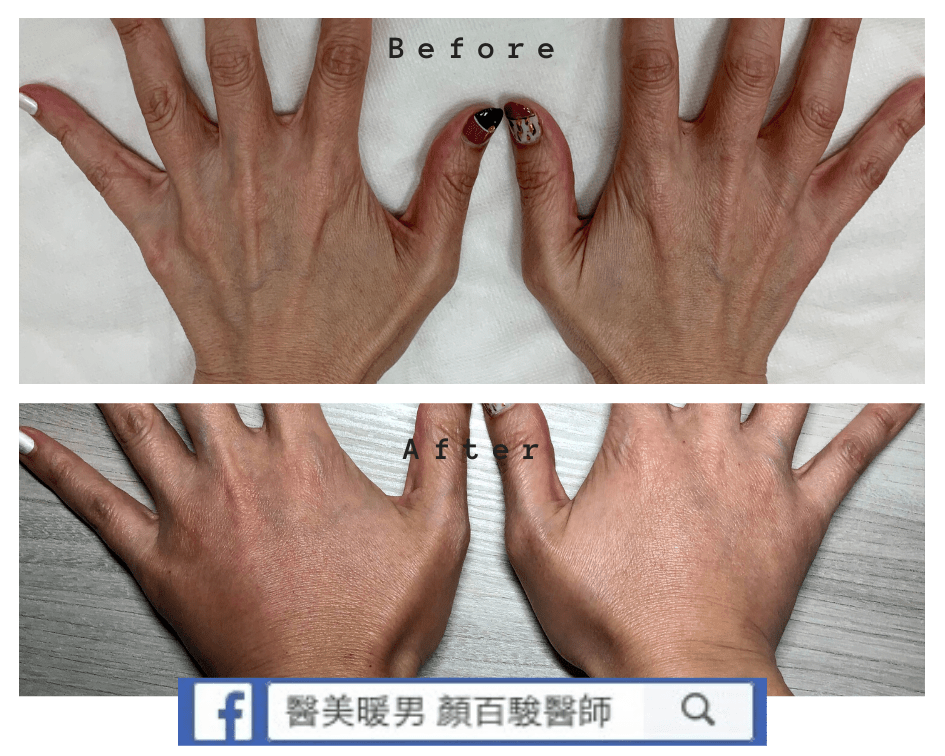 Read more about the article 晶亮瓷(雞爪手)案例