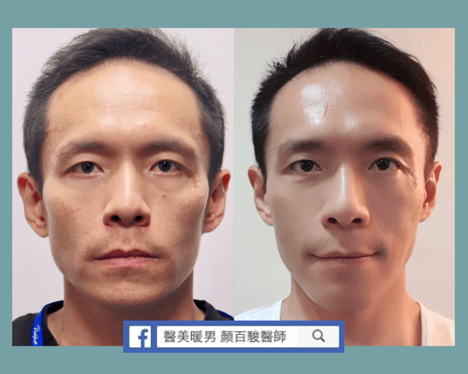 Read more about the article 舒顏萃(童顏針)案例