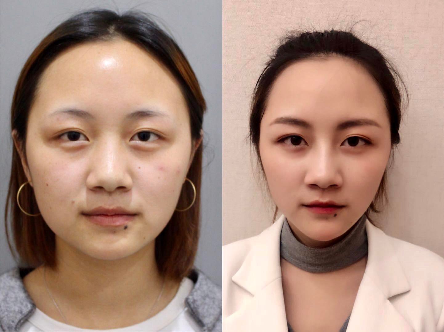 Read more about the article 複合式微整案例
