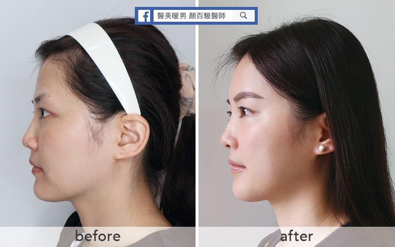 Read more about the article 豐額填充案例
